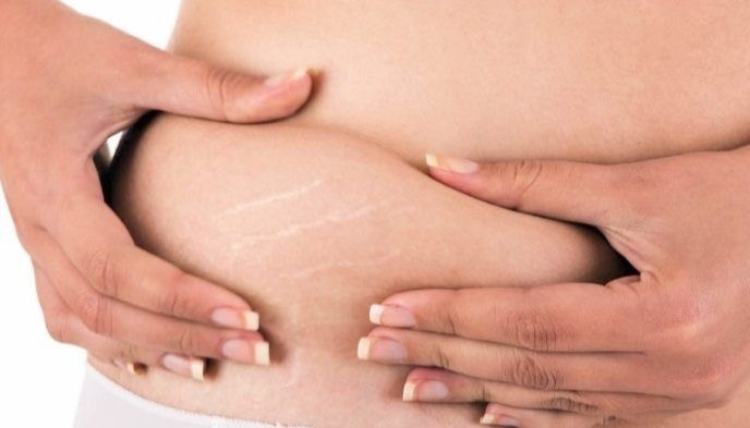 Растяжки на коже: как решить проблему